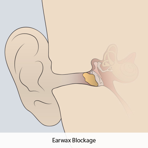 Earwax Blockage